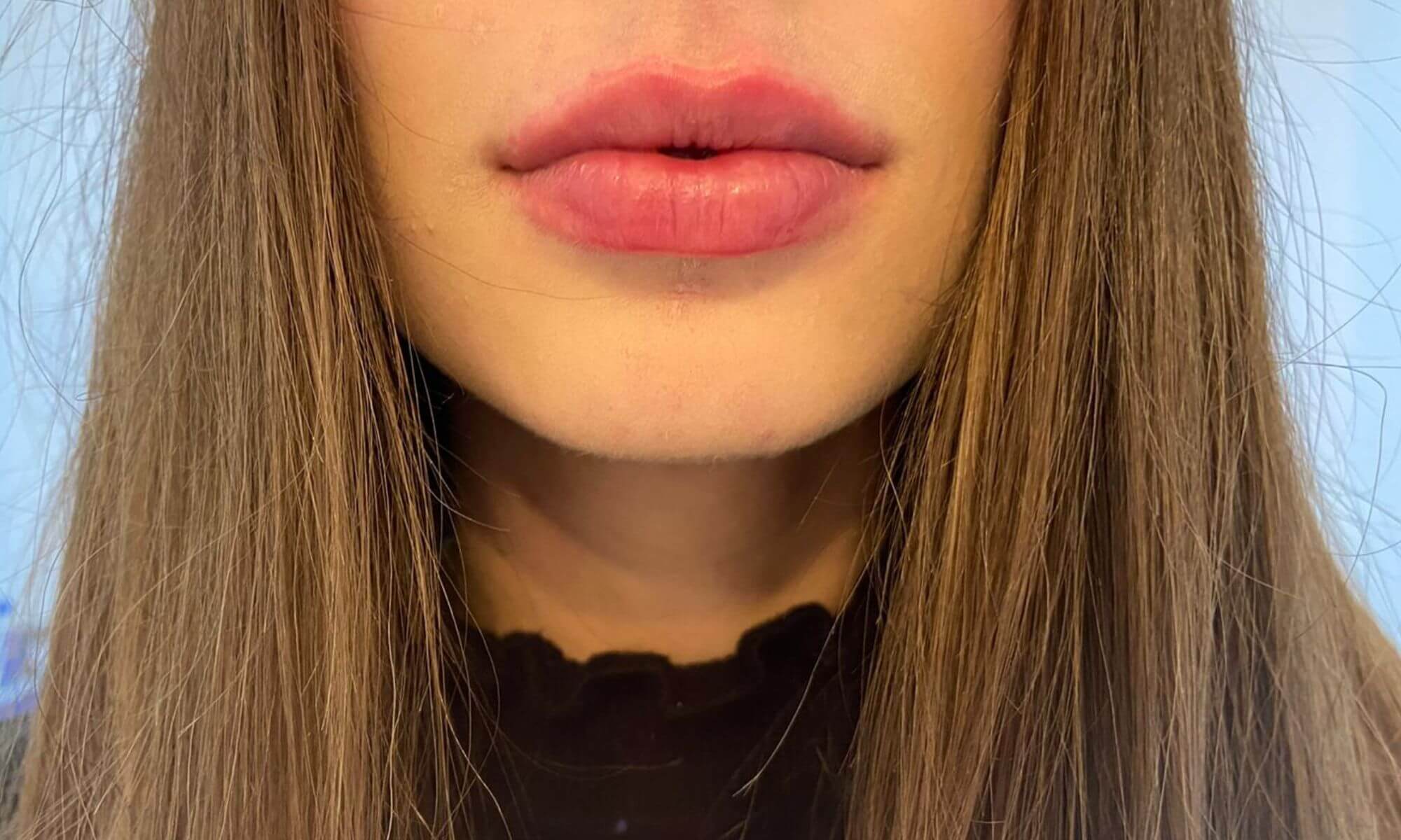 Ce să faci dacă ai buze umflate după acid hialuronic