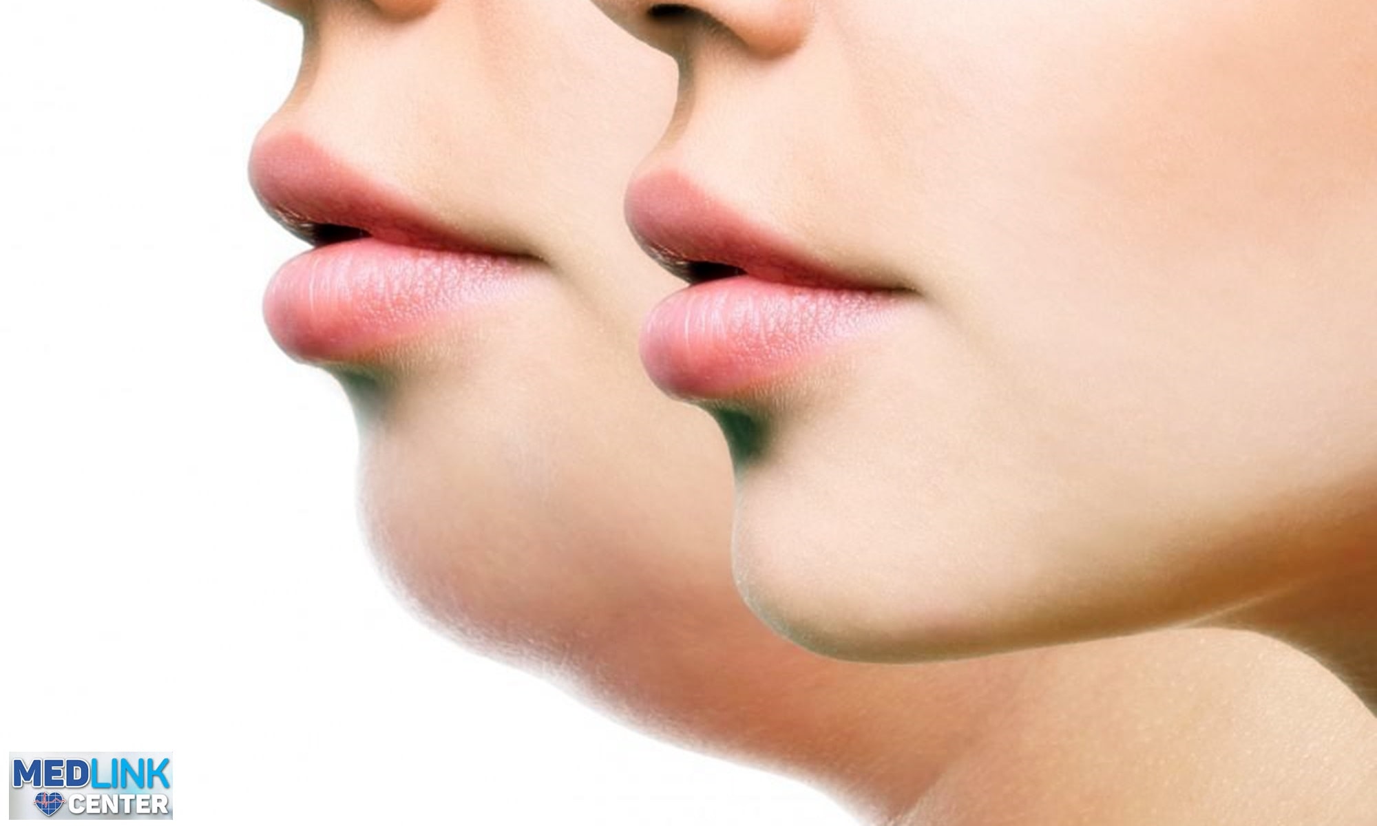 Kybella - tratamentul pentru reducerea bărbiei duble