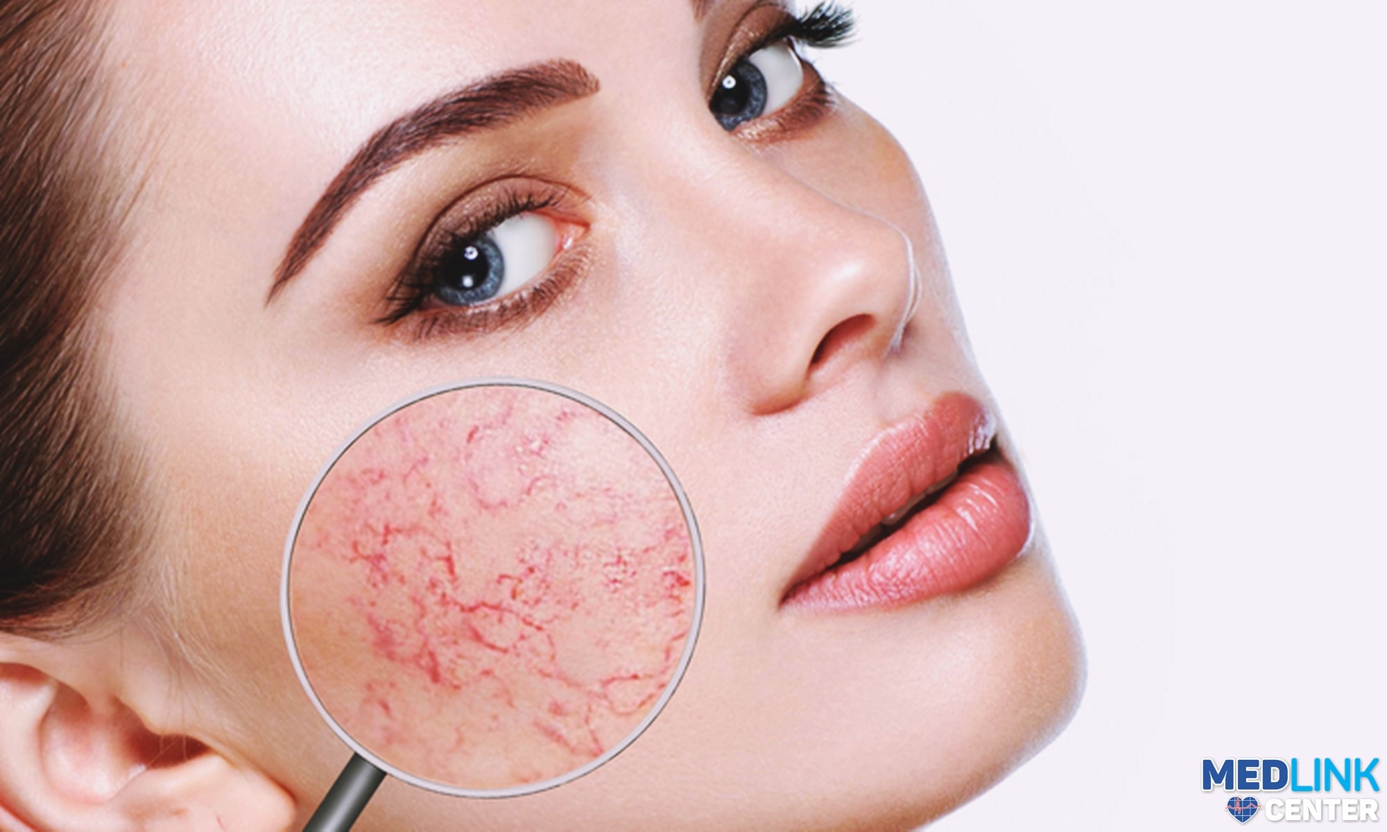 Rozaceea – cauze, manifestare și sfatul dermatologului