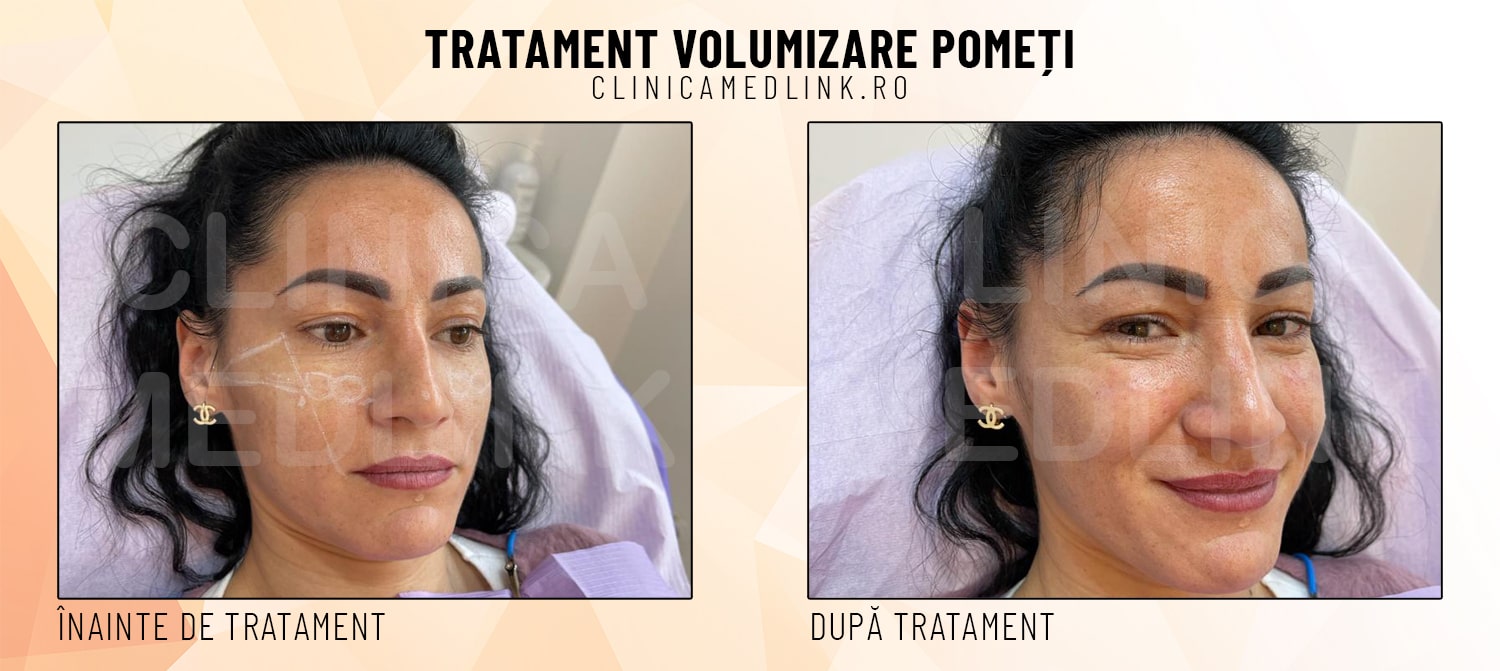 before after volumizare pometi clinica medlink