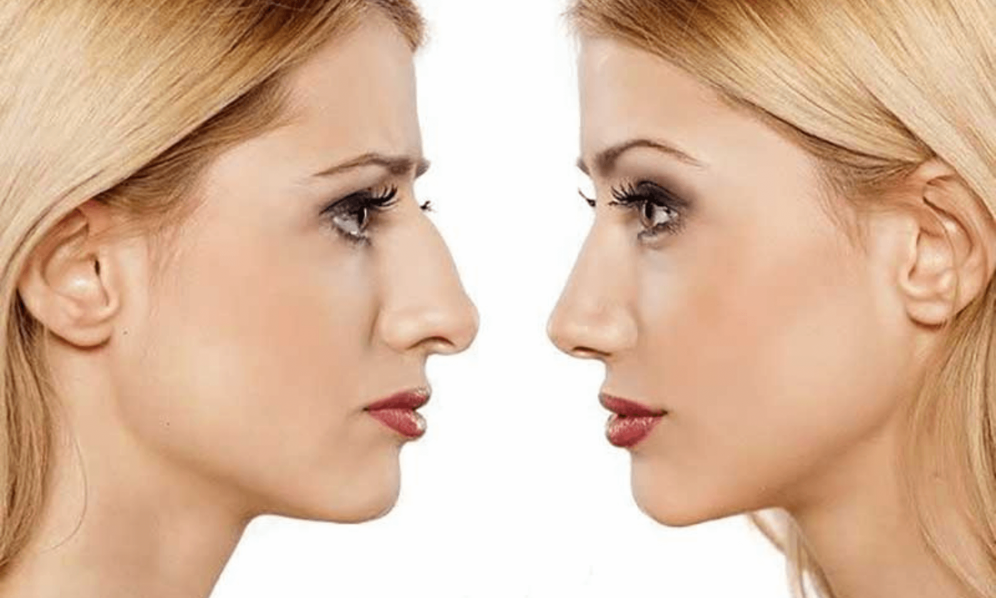 rinoplastie non-chirurgicala rinoplastie non-chirurgicală