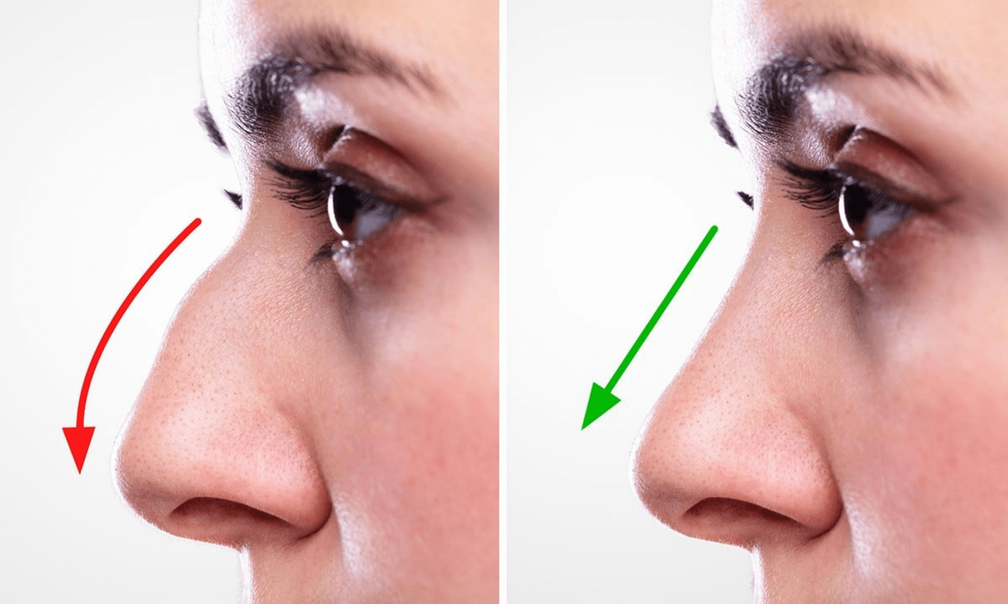rinoplastie nonchirurgicala
