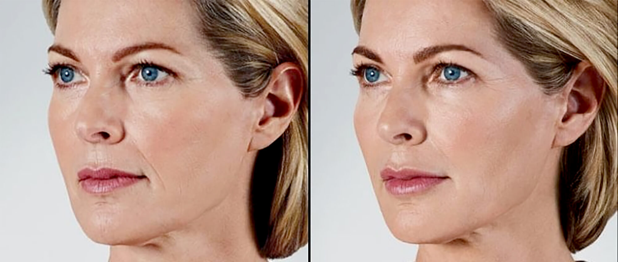 augmentarea pometilor acid hialuronic dermatologie estetica medlink center craiova