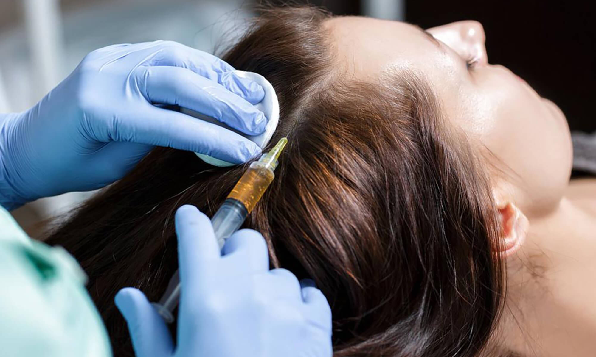 terapia prp contra subtierea parului medlink center craiova estetica dermatologie