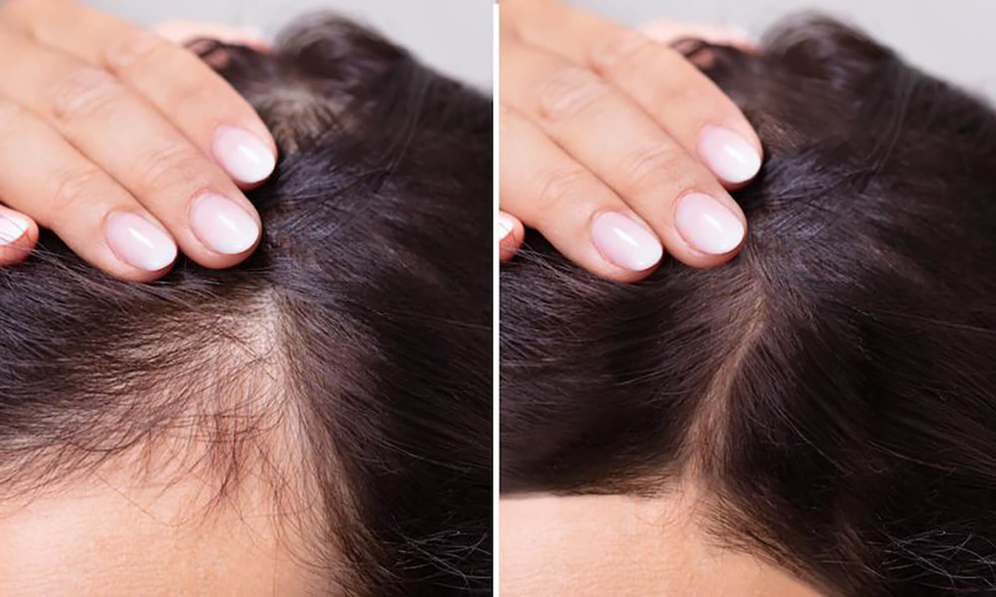subtierea parului inainte dupa rezultate terapia prp medlink center craiova estetica dermatologie